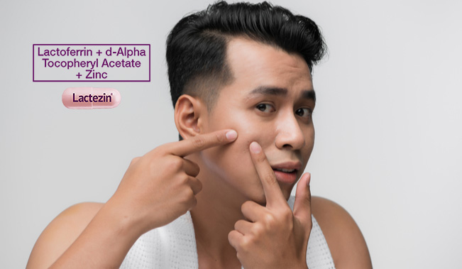 5-types-of-acne-and-how-to-heal-them
