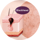 blackheads-category-img