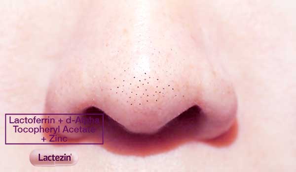 sebaceous-filaments-or-blackheads-on-nose