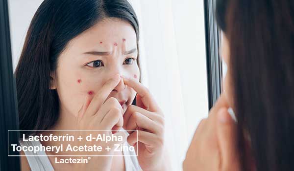 pimple-treatments-for-pimples-that-wont-go-away