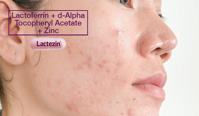 the-dos-and-donts-of-inflammatory-acne-treatment